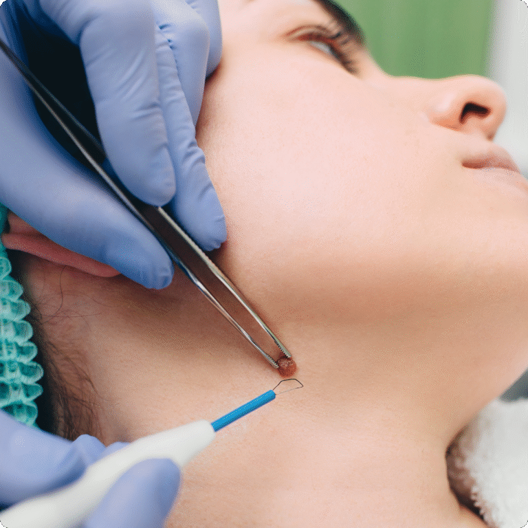 warts and moles treatment