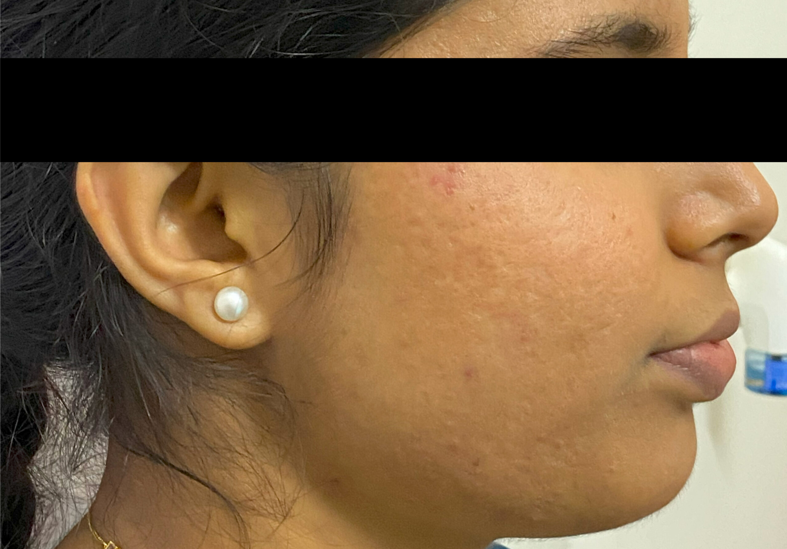 1-TEENAGE PCOS ACNE- ORAL MED + ACNE PEELS +CARBON FACIALIMG_4724