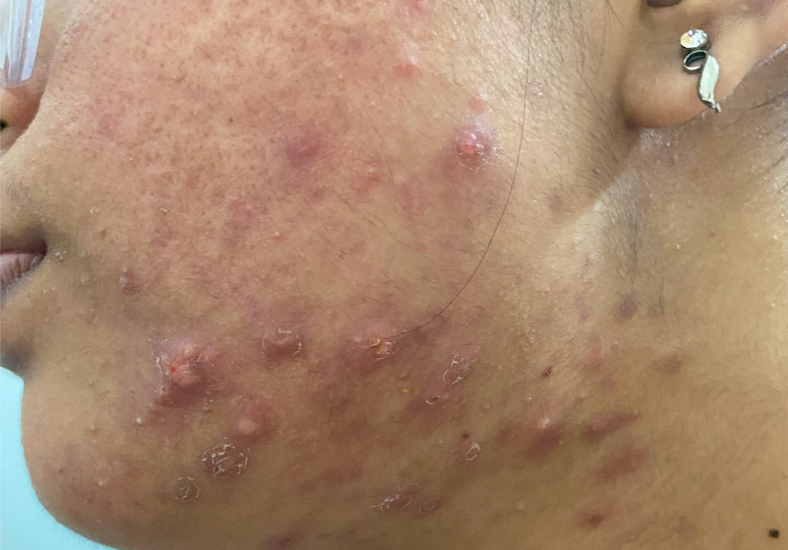 1-TEENAGE PCOS ACNE- ORAL MED + ACNE PEELS +CARBON FACIALIMG_9661