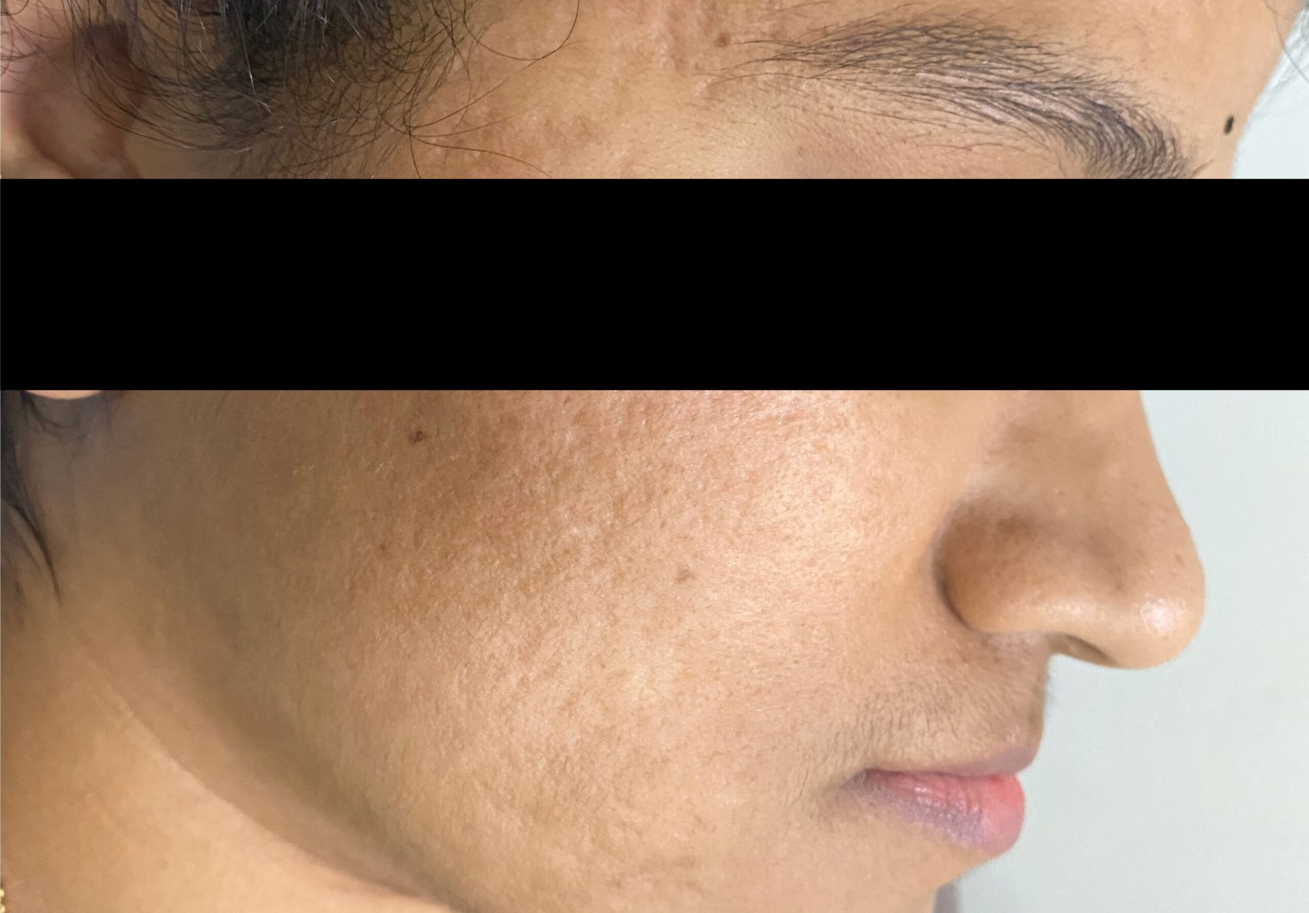 ACNE SCARS- COMBINATION TREATMENT-MICRONEEDLING+SUBSCISION+SKIN-GFC INJECTABLES UNDER SCARS; AFTERIMG_6379