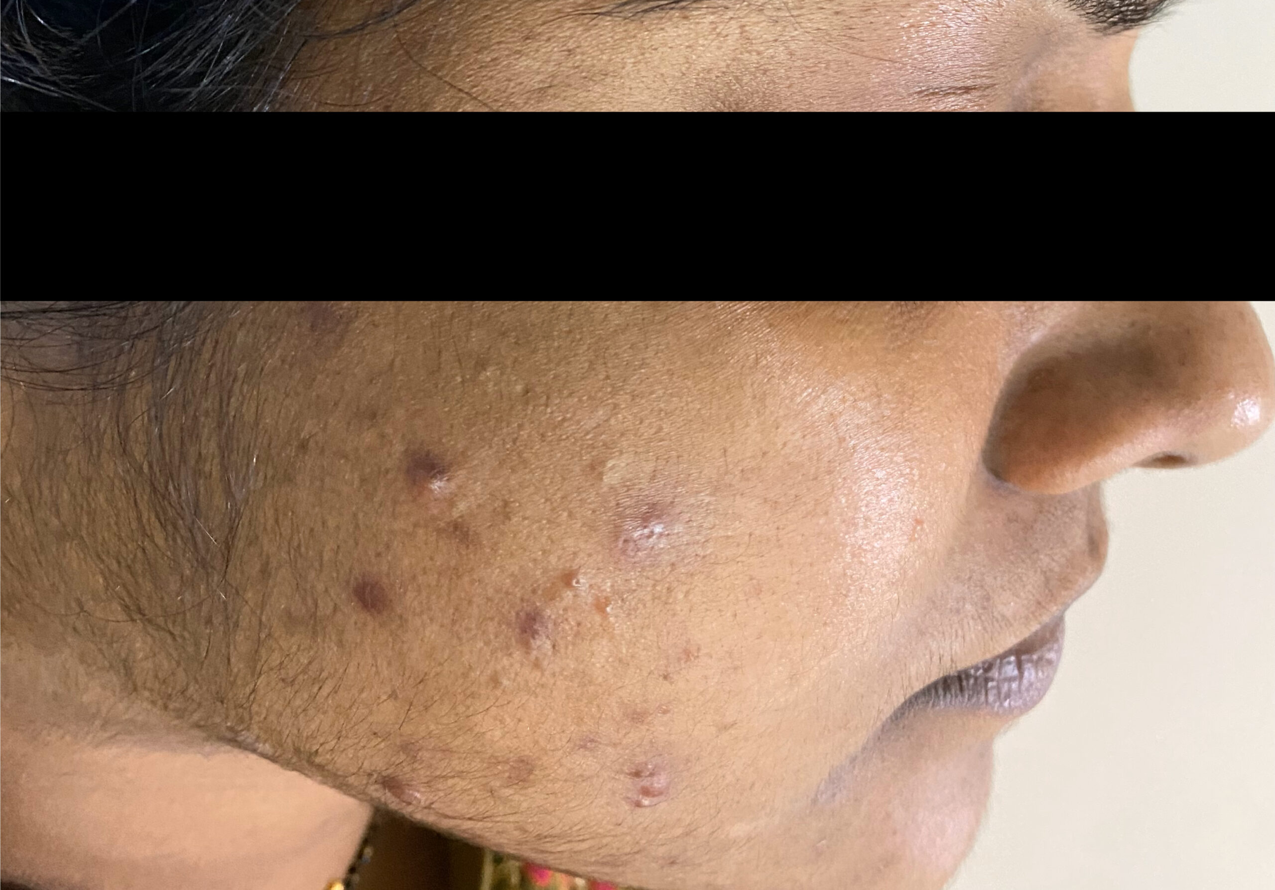 ADULT ACNE- ACNE PEELS + CARBON FACIALIMG_2605