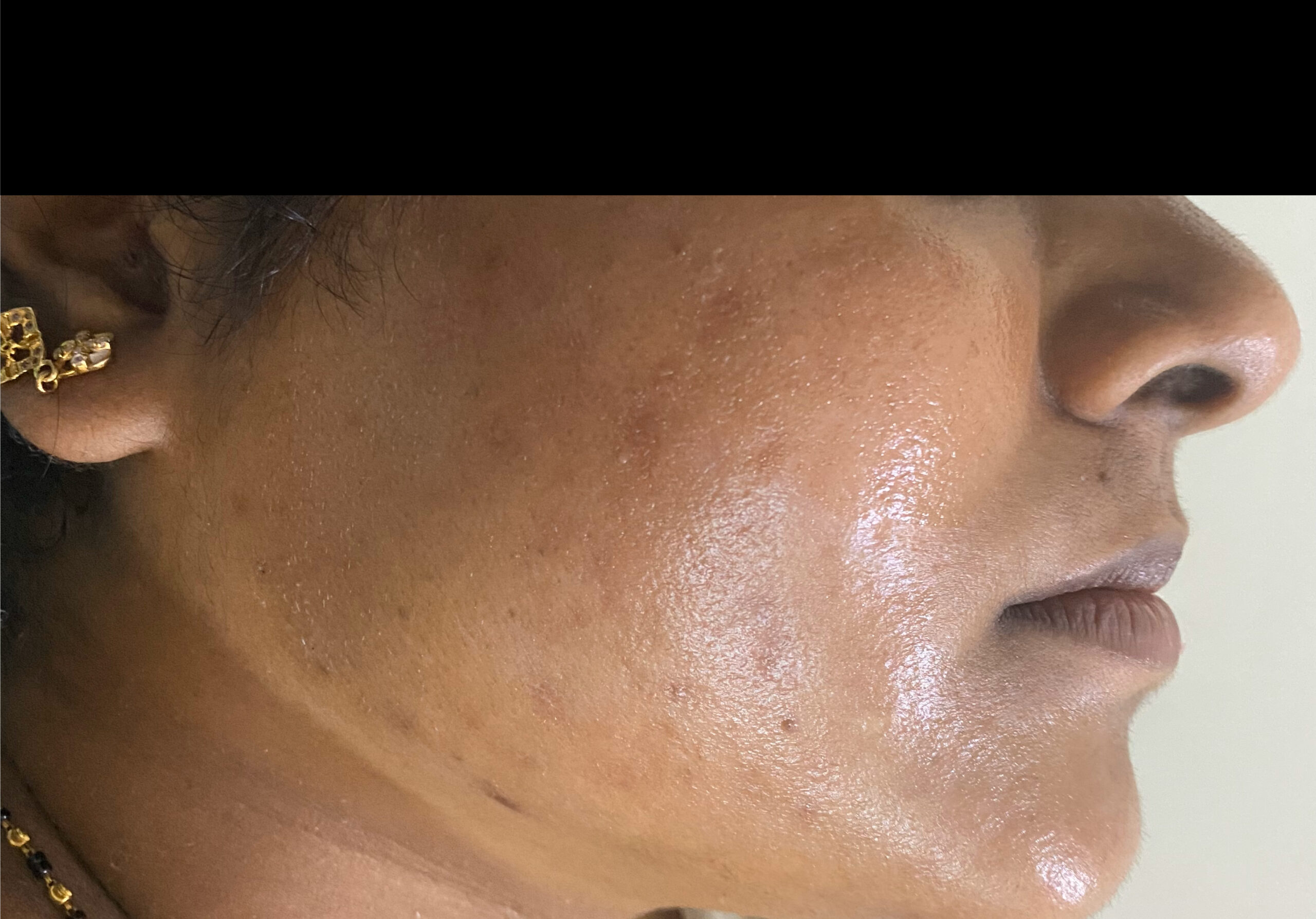 ADULT ACNE- ACNE PEELS + CARBON FACIALIMG_9400