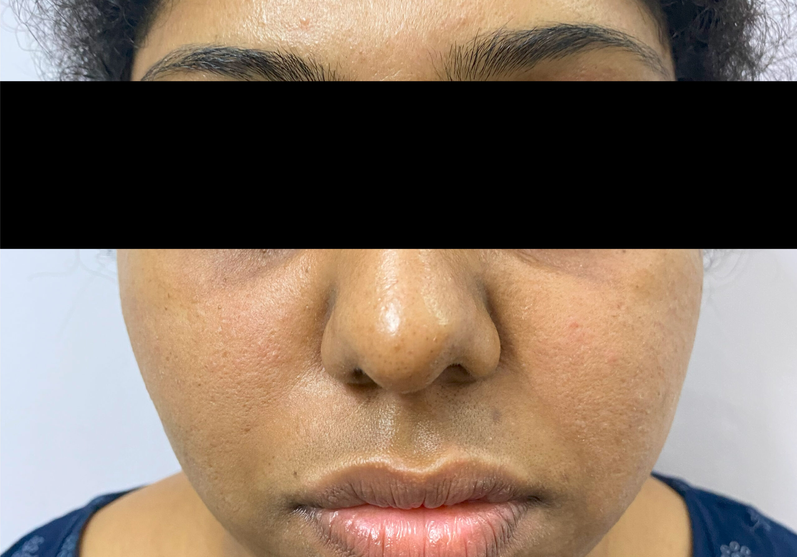 AFTER CARBON FACIAL TONING IMG_9041