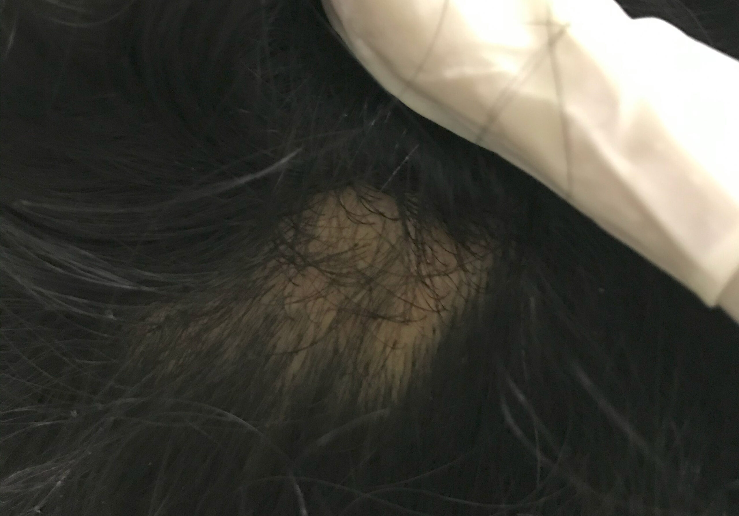 AFTER TREATMENT -TOTAL REGROWTH OF HAIR