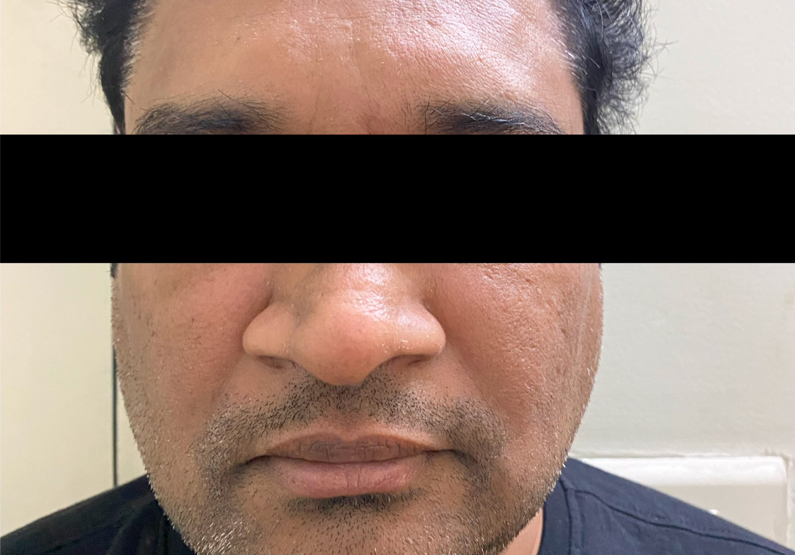 AFTER TREATMENT WITH BOTOX & FILLERS- LOST FACE VOLUME REPLACED AND WRNKLES REDUCED