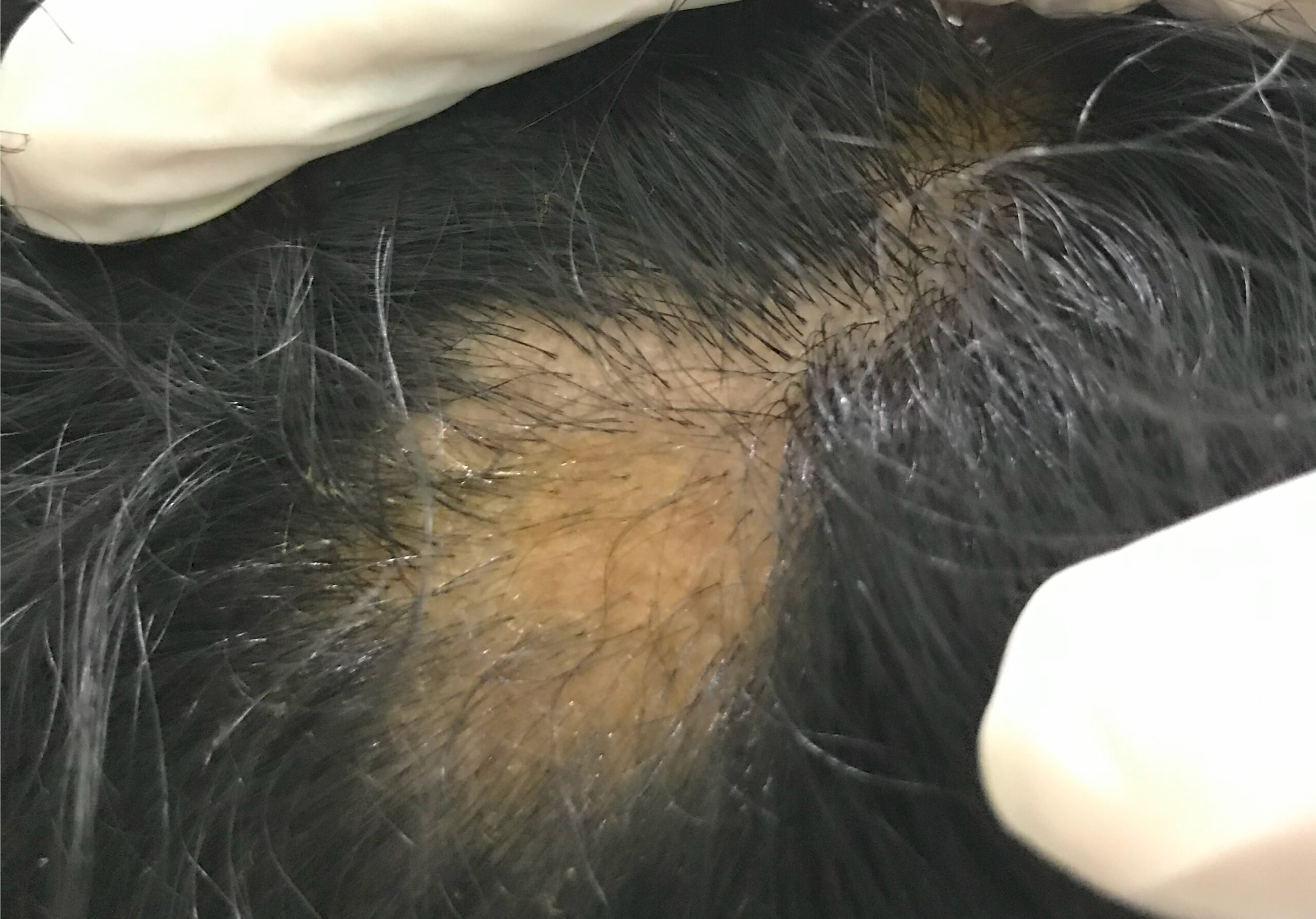 ALOPECIA AREATA-PATCHY HAIR LOSS- STAGES OF HAIR-REGROWTH AFTER ILS INJECTABLE + MEDICATIONSIMG_1763