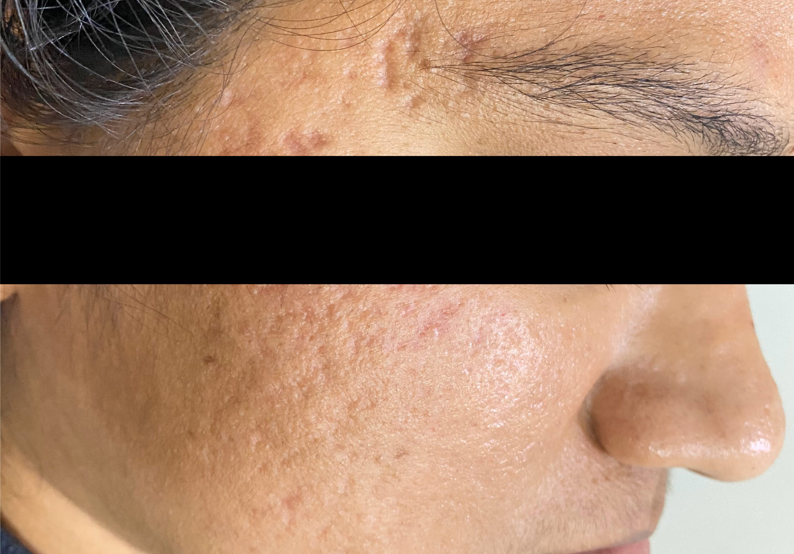 BEFORE-ACNE SCARS- COMBINATION TREATMENT-MICRONEEDLING+SUBSCISION+SKIN-GFC INJECTABLES UNDER SCARS; IMG_0831