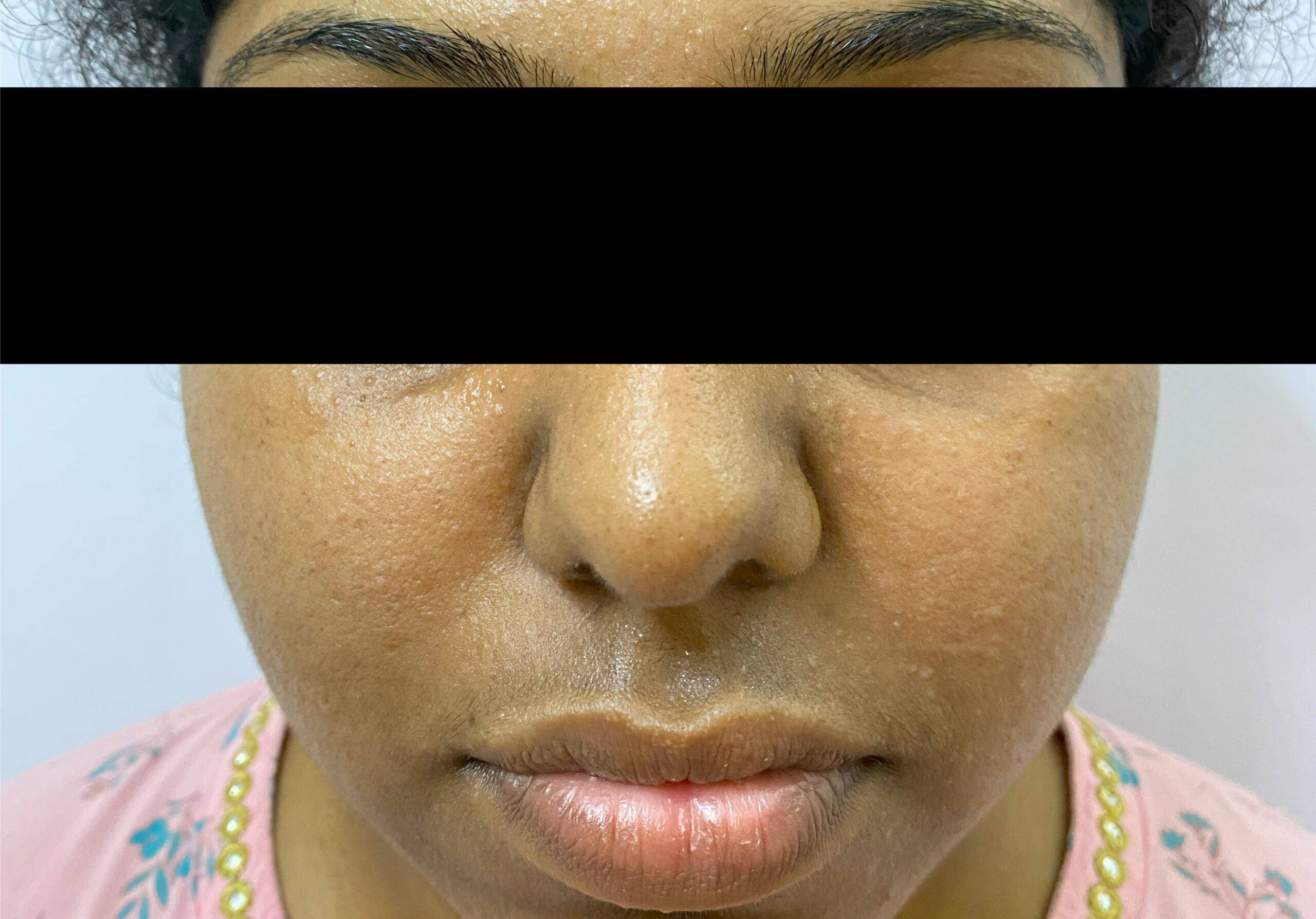 BEFORE TREATMENT oily skin and rough textureIMG_7826