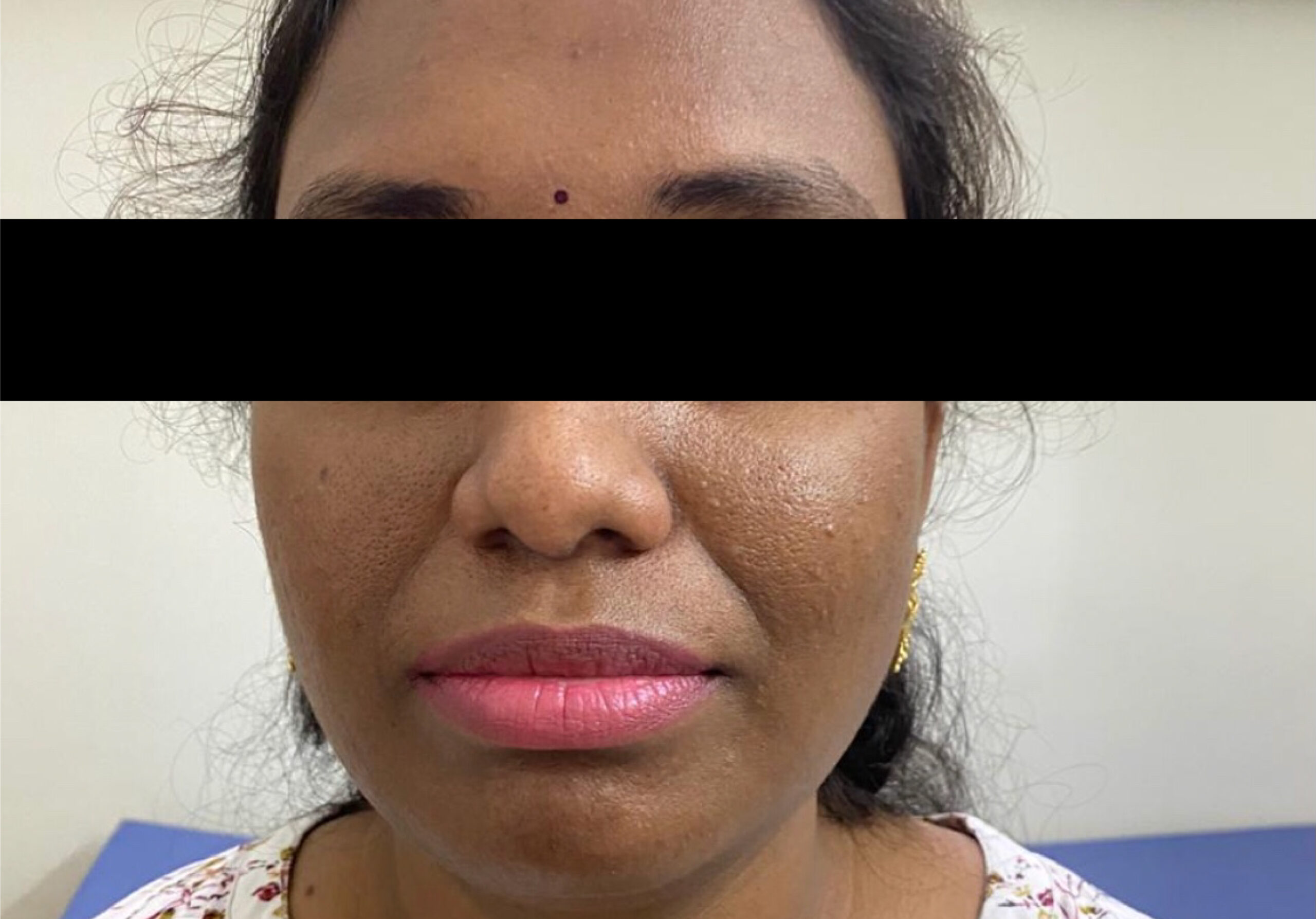 FACE PIGMENTATION BEFORE AND AFTER, COSMELAN PEEL TREATMENTIMG_3182
