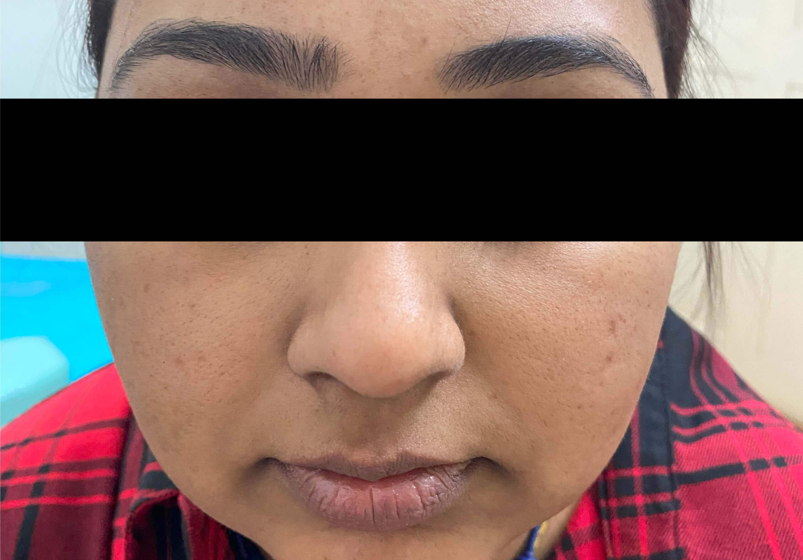 FACE TAN, UNEVEN SKIN, MILD ACNE TREATED WITH CARBON FACIAL + FACIAL TONING + GLOW PEELS