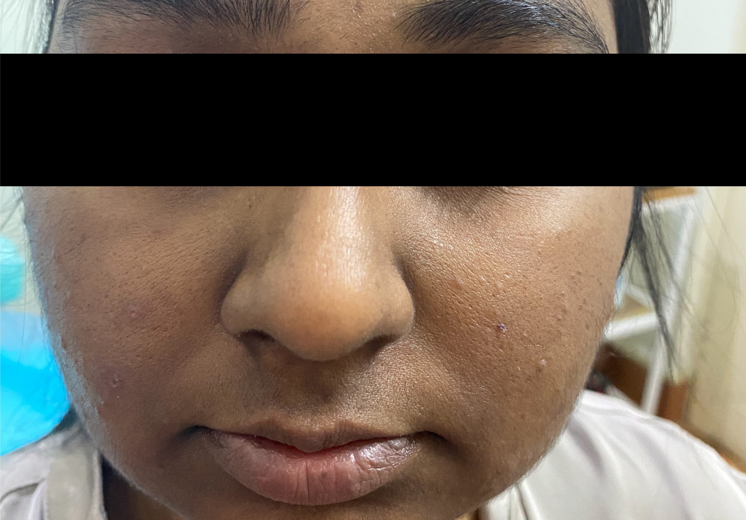 FACE TAN, UNEVEN SKIN TONE MILD ACNE1st IMG_5584