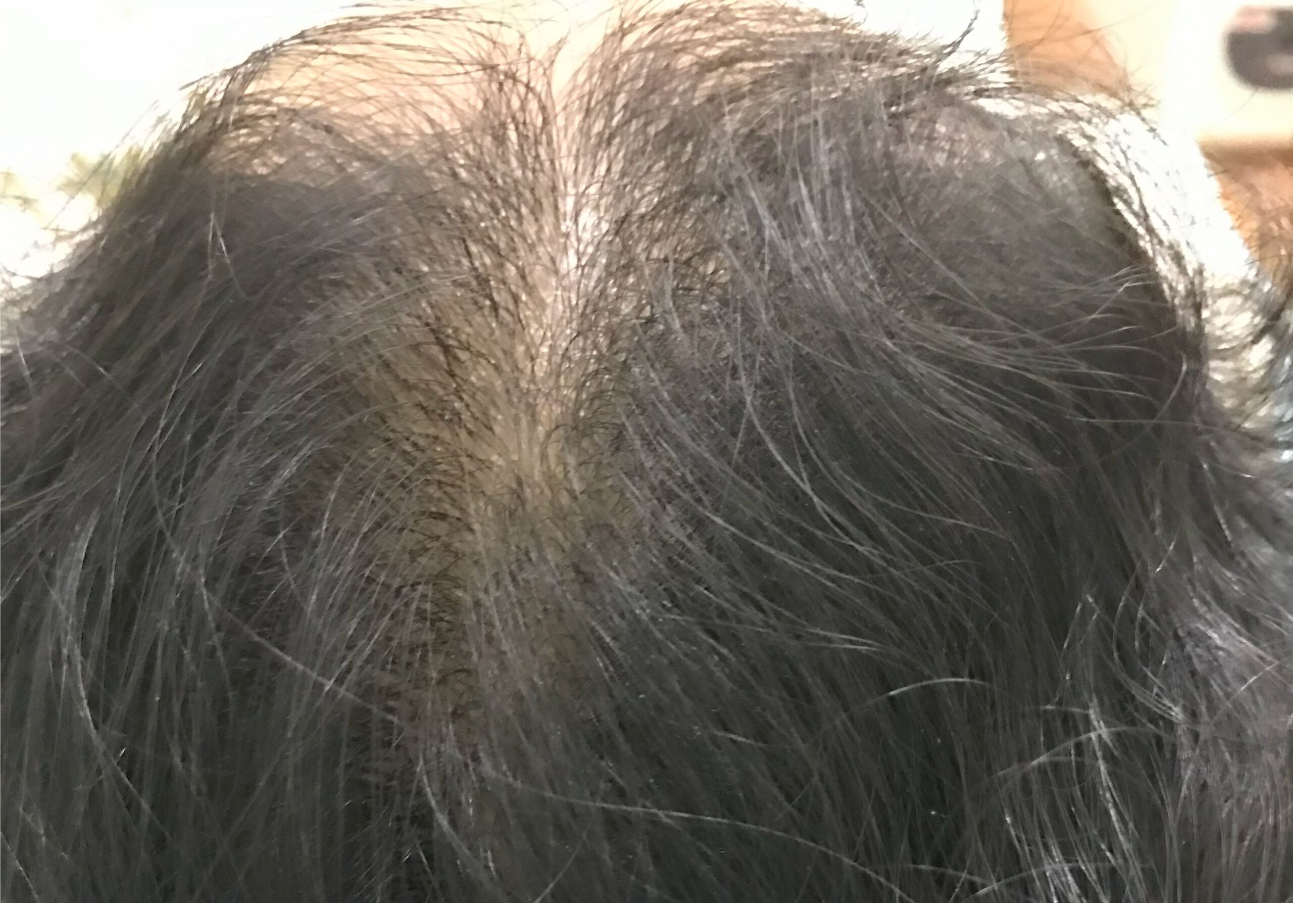 FEMALE hair loss treated with GFC-HAIR