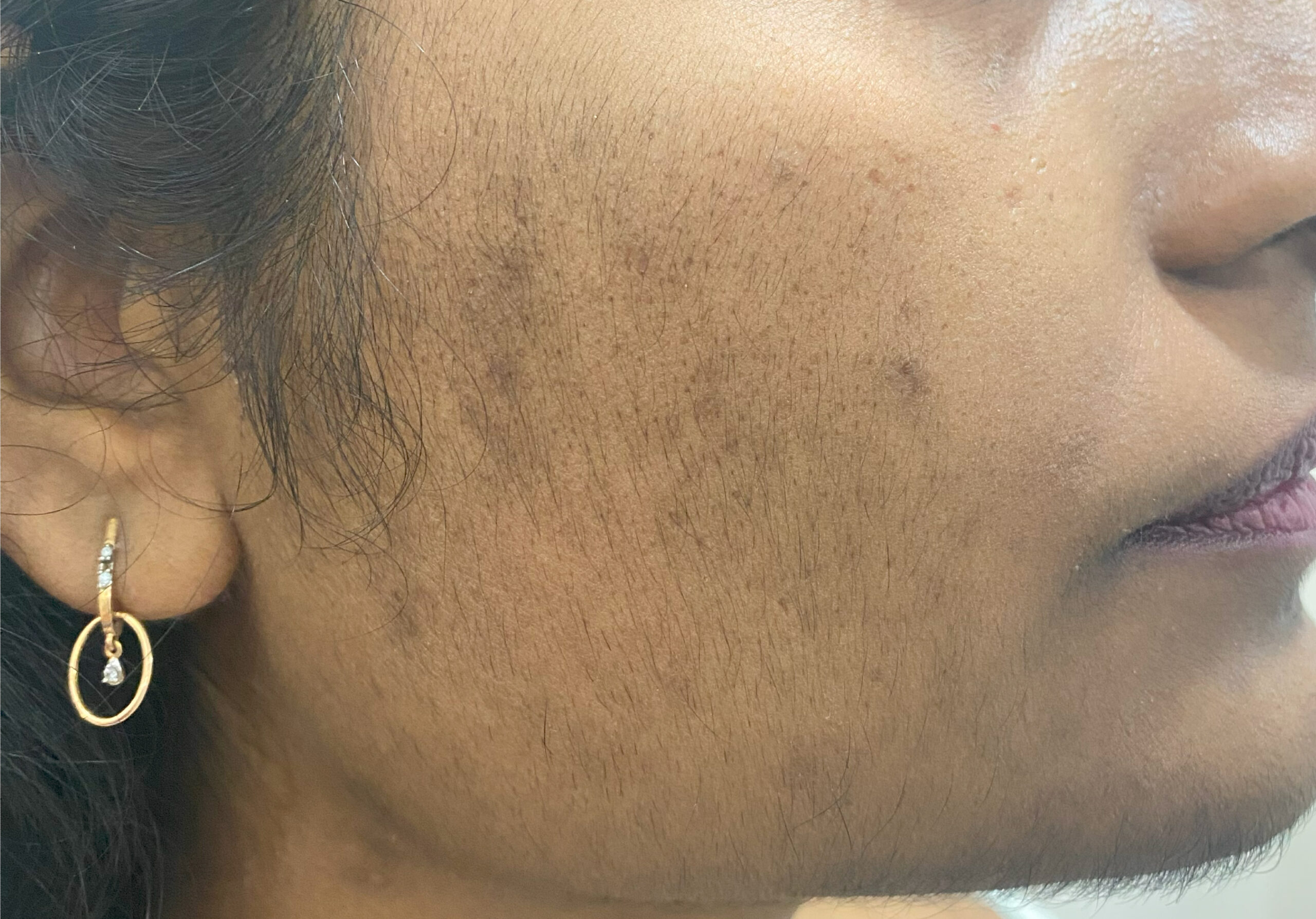 HAIR removal laser IMG_0511