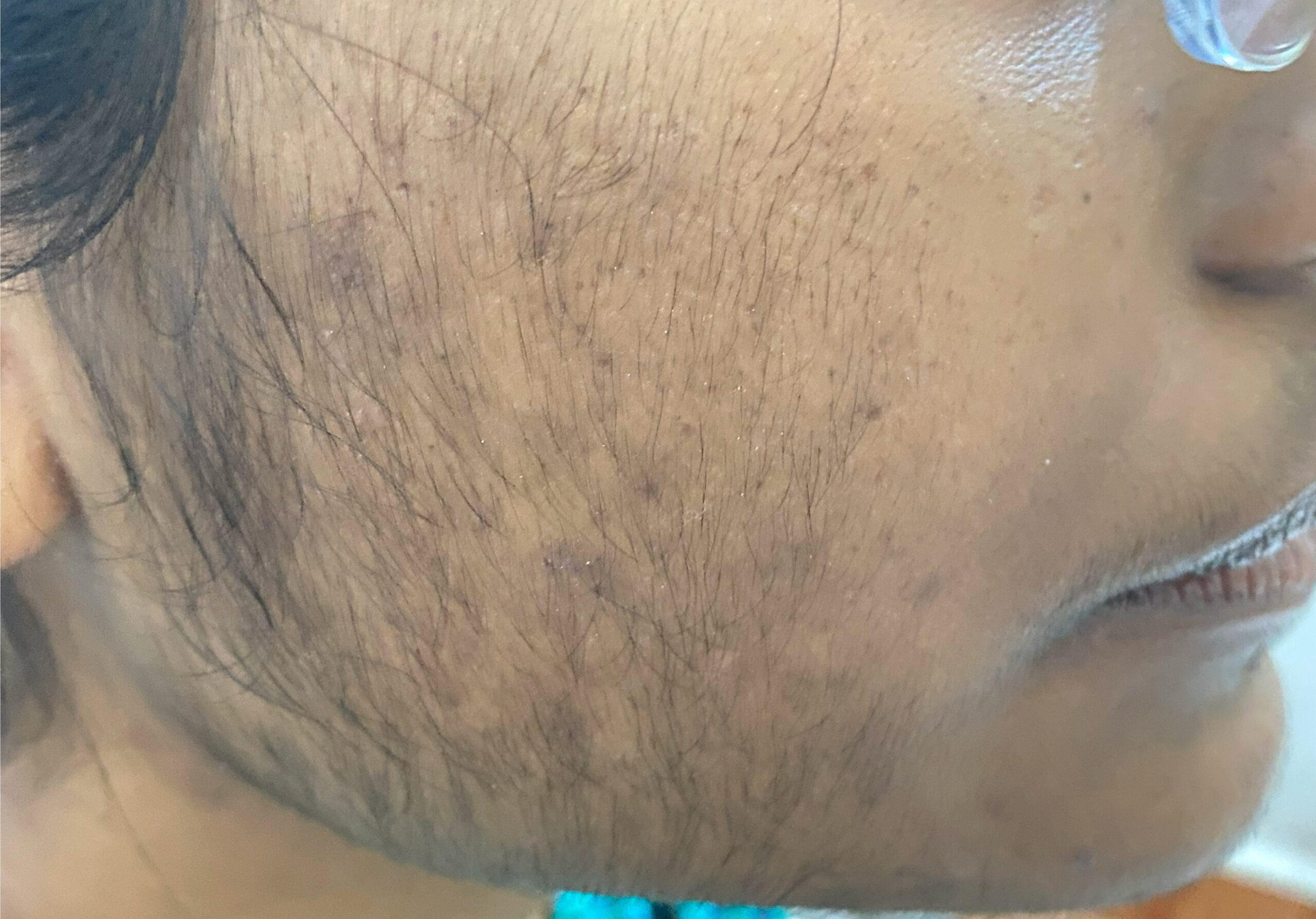 HAIR removal laser IMG_5093