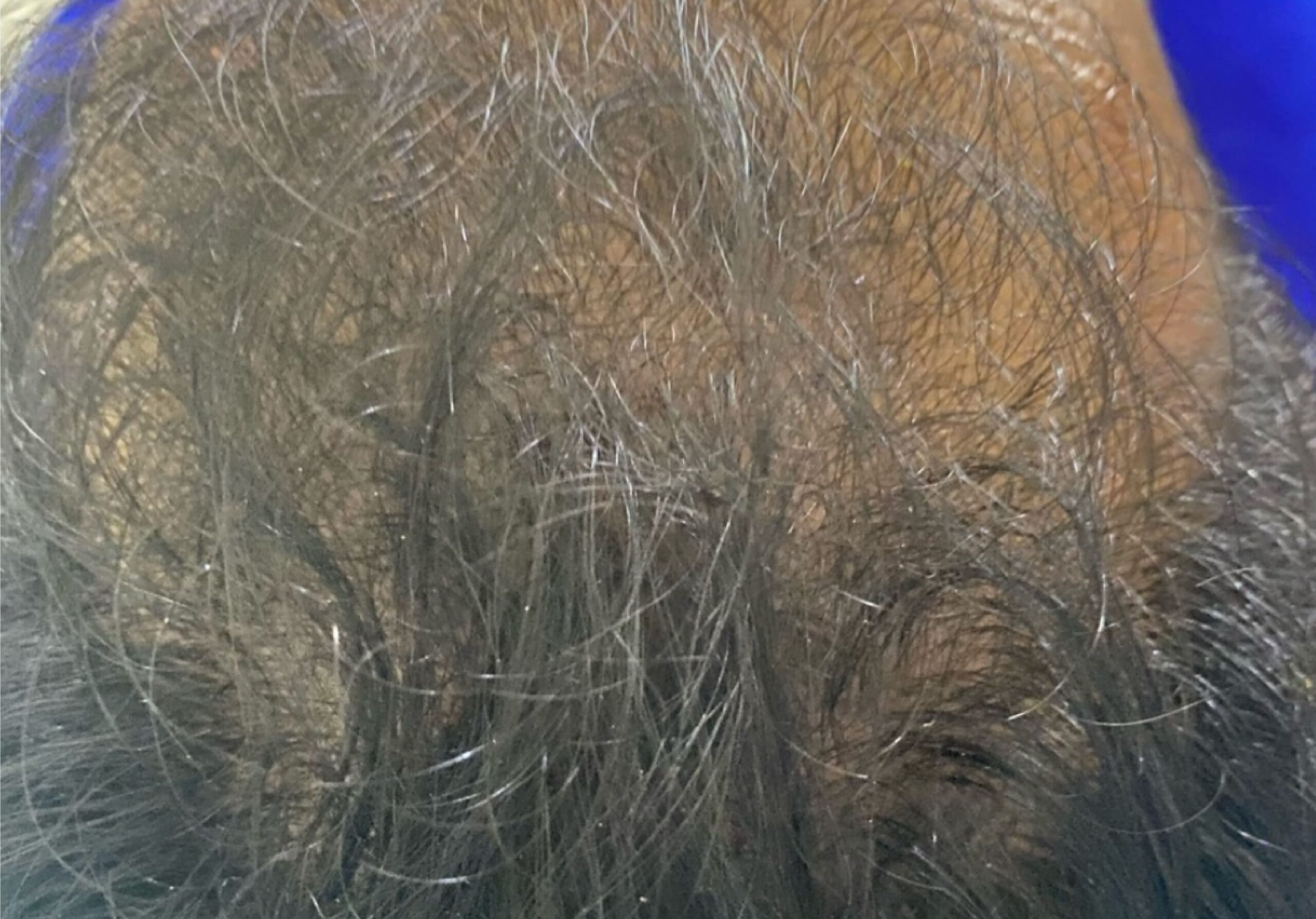 MALE PATTERN BALDNESS IMG_6127