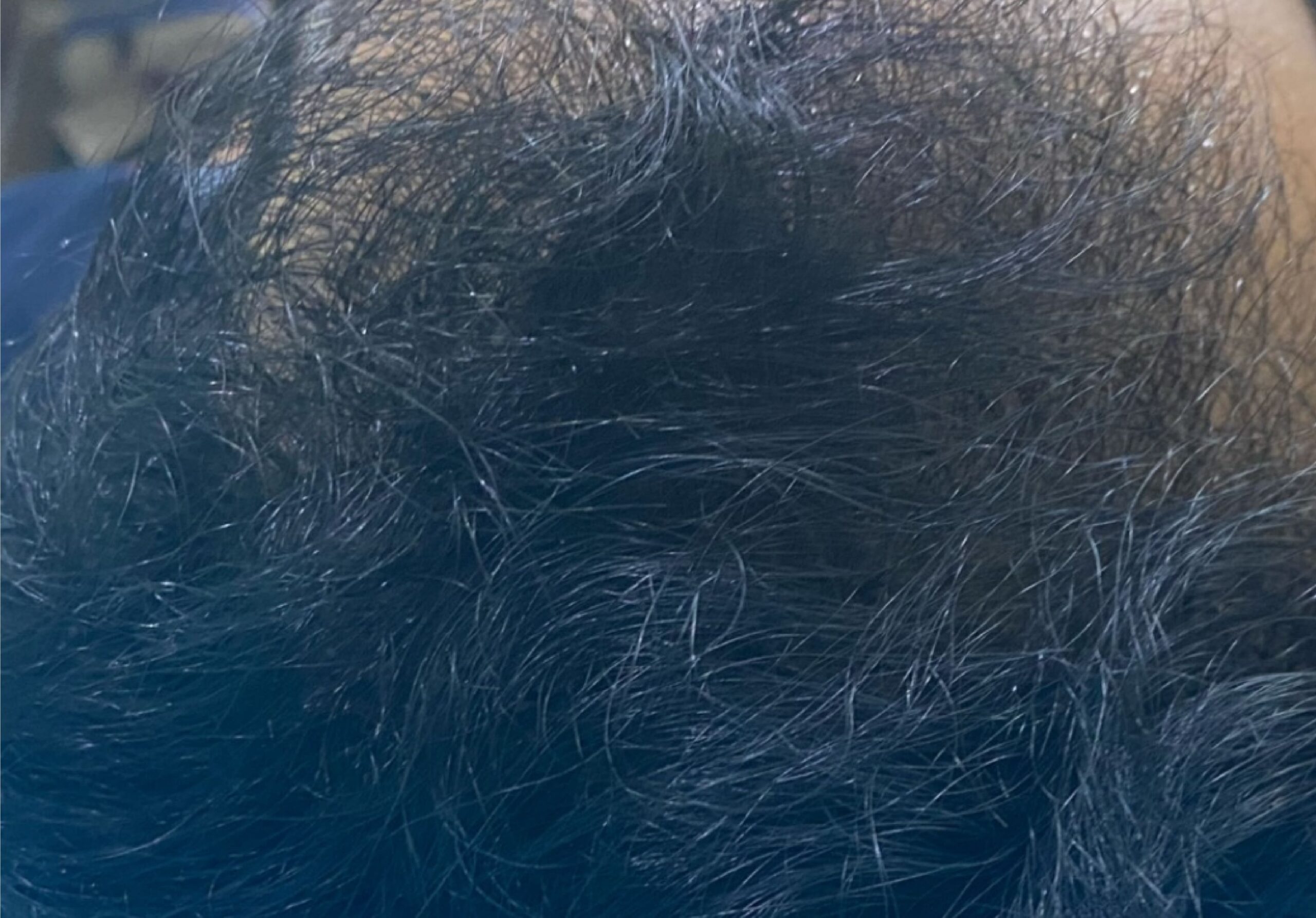 MALE PATTERN BALDNESS TREATED WITH HAIR-GFC + QR678