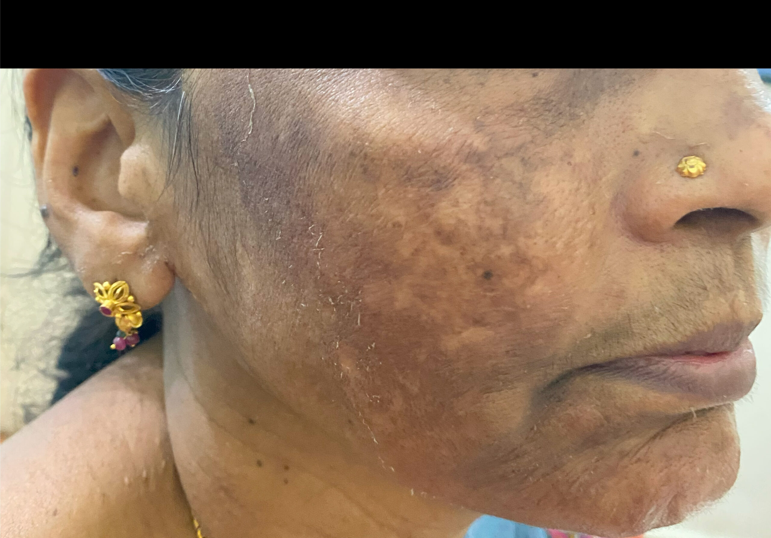 MELASMA 3 - BEOFRE