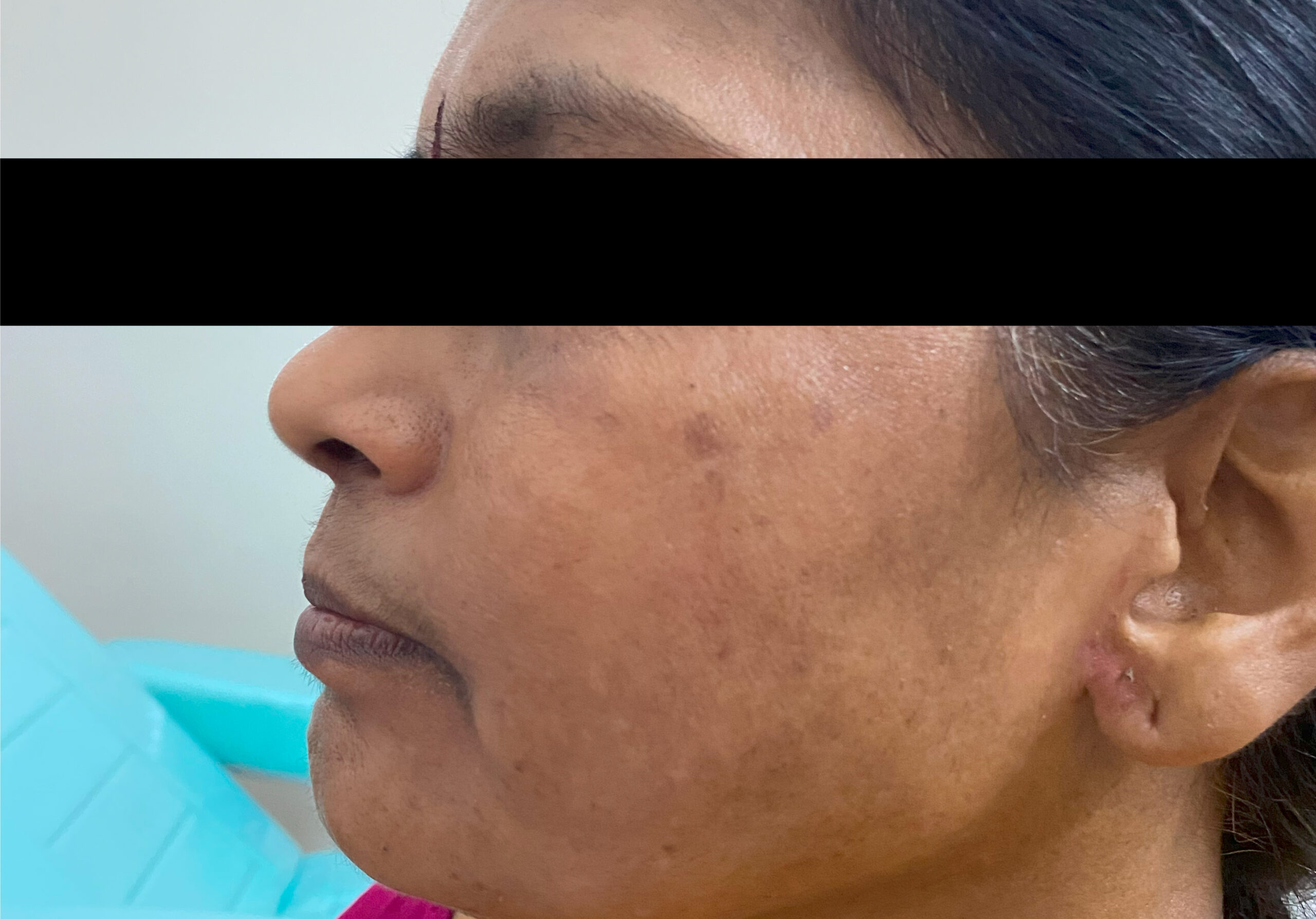 MELASMA 5-TREATED WITH HOME CARE +COSMELAN PEEL