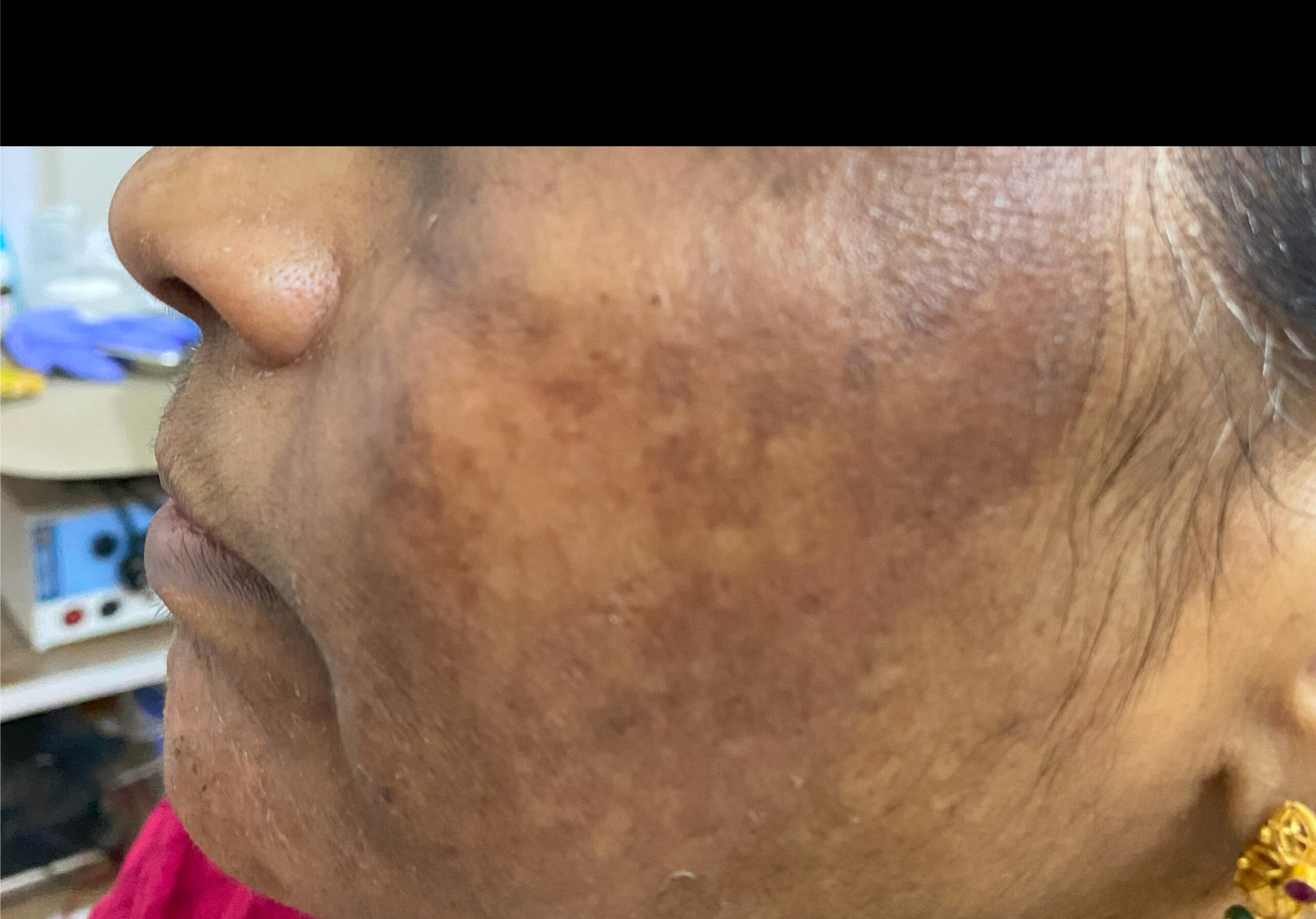 MELASMA 5IMG_8667