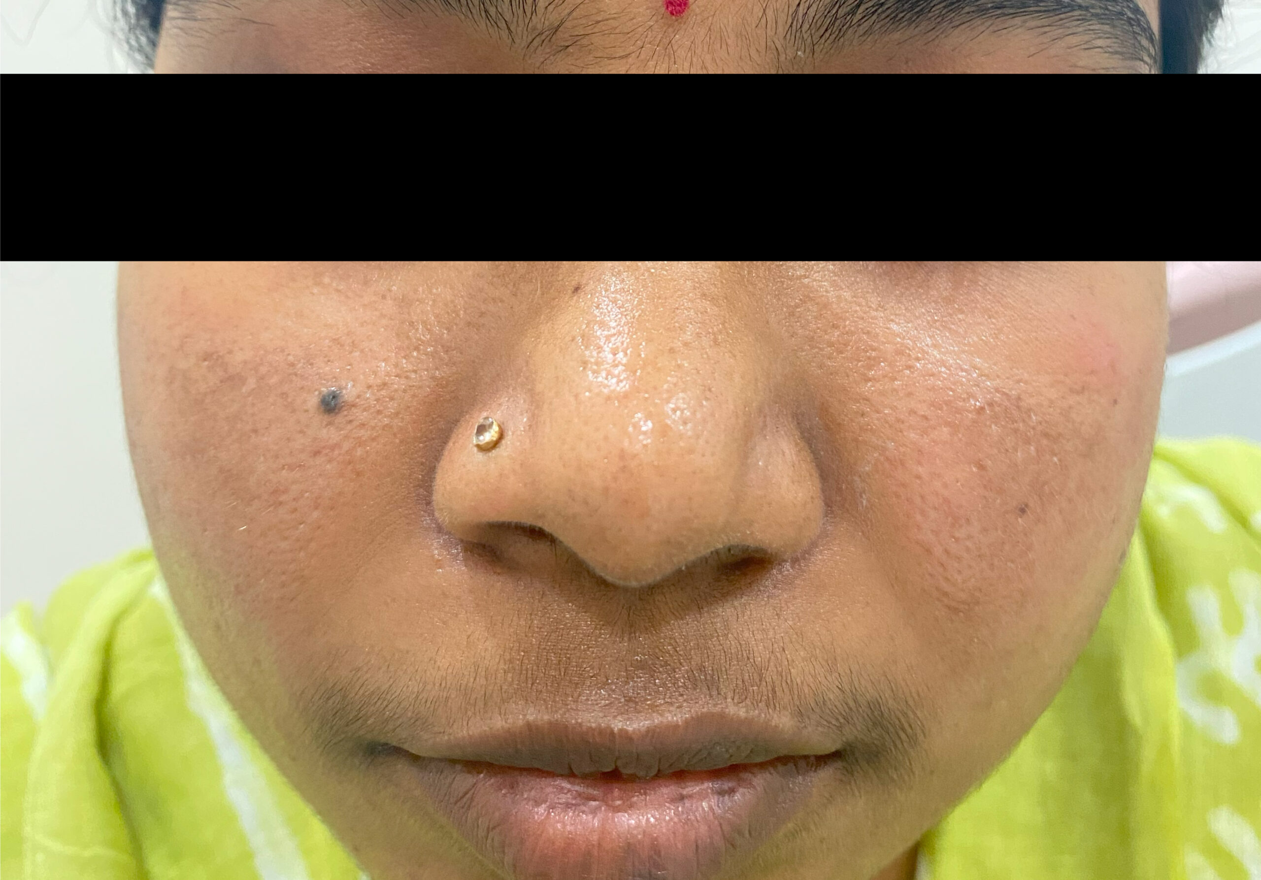 MELASMA PATIENT 1 - COSMELAN SPOT TREATMENTIMG_2465