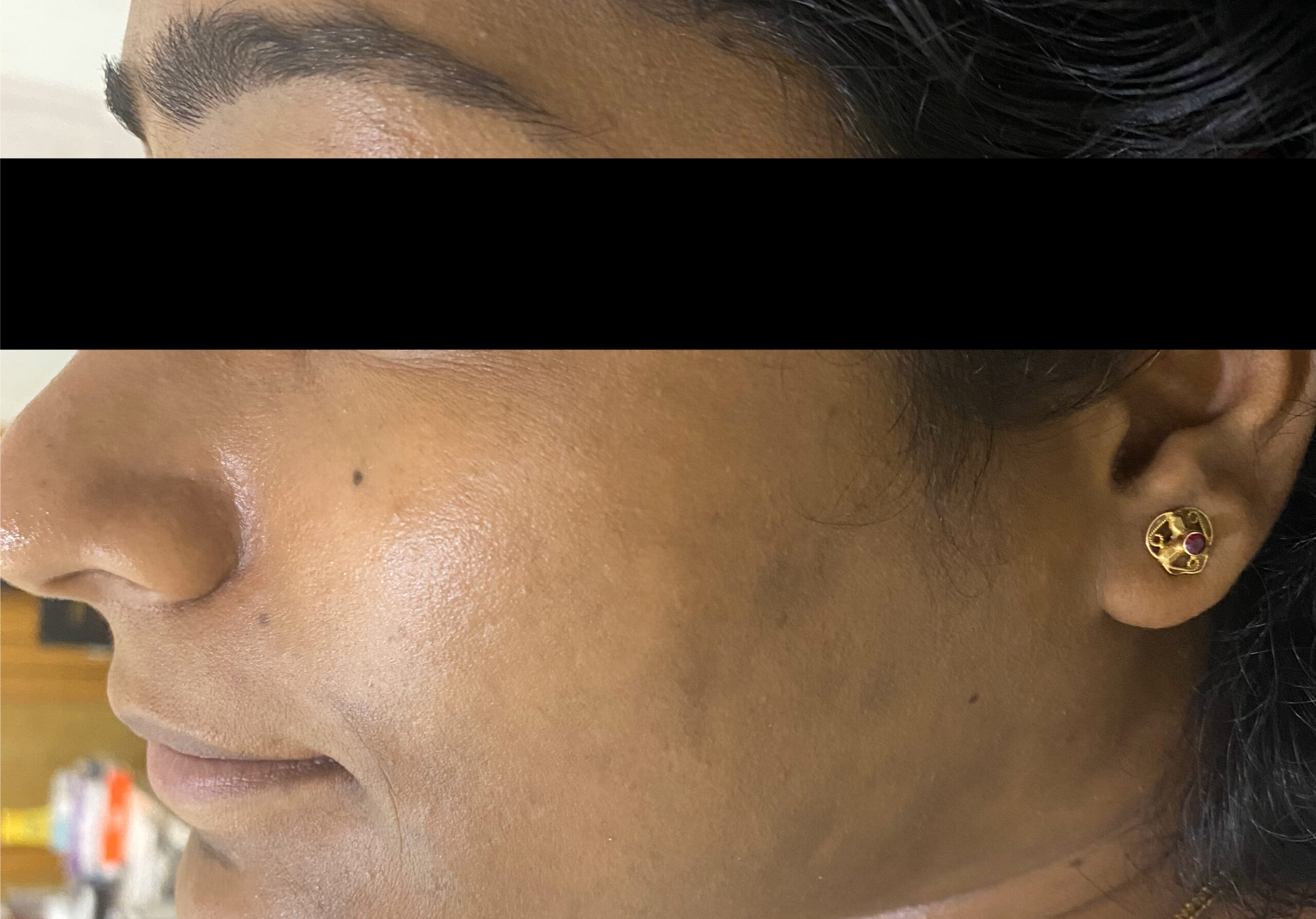 PIGMENTATION LPP- TREATED WITH ORAL MED+ LASER TONING+ RETINOL PEELS