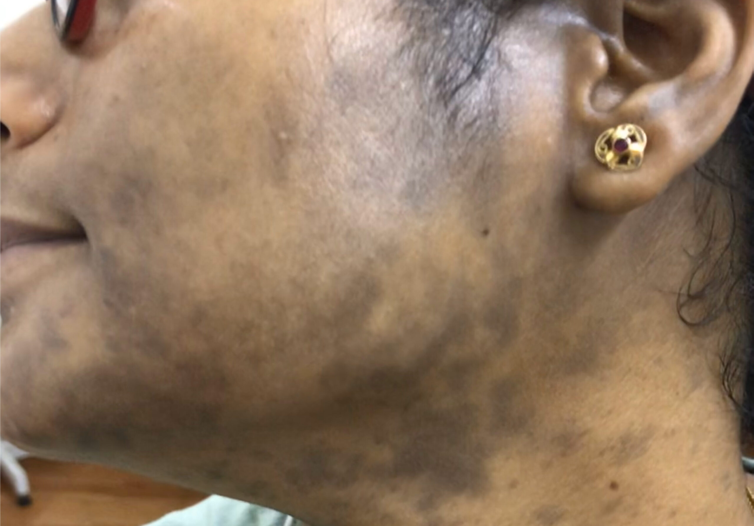 PIGMENTATION LPPIMG_2004