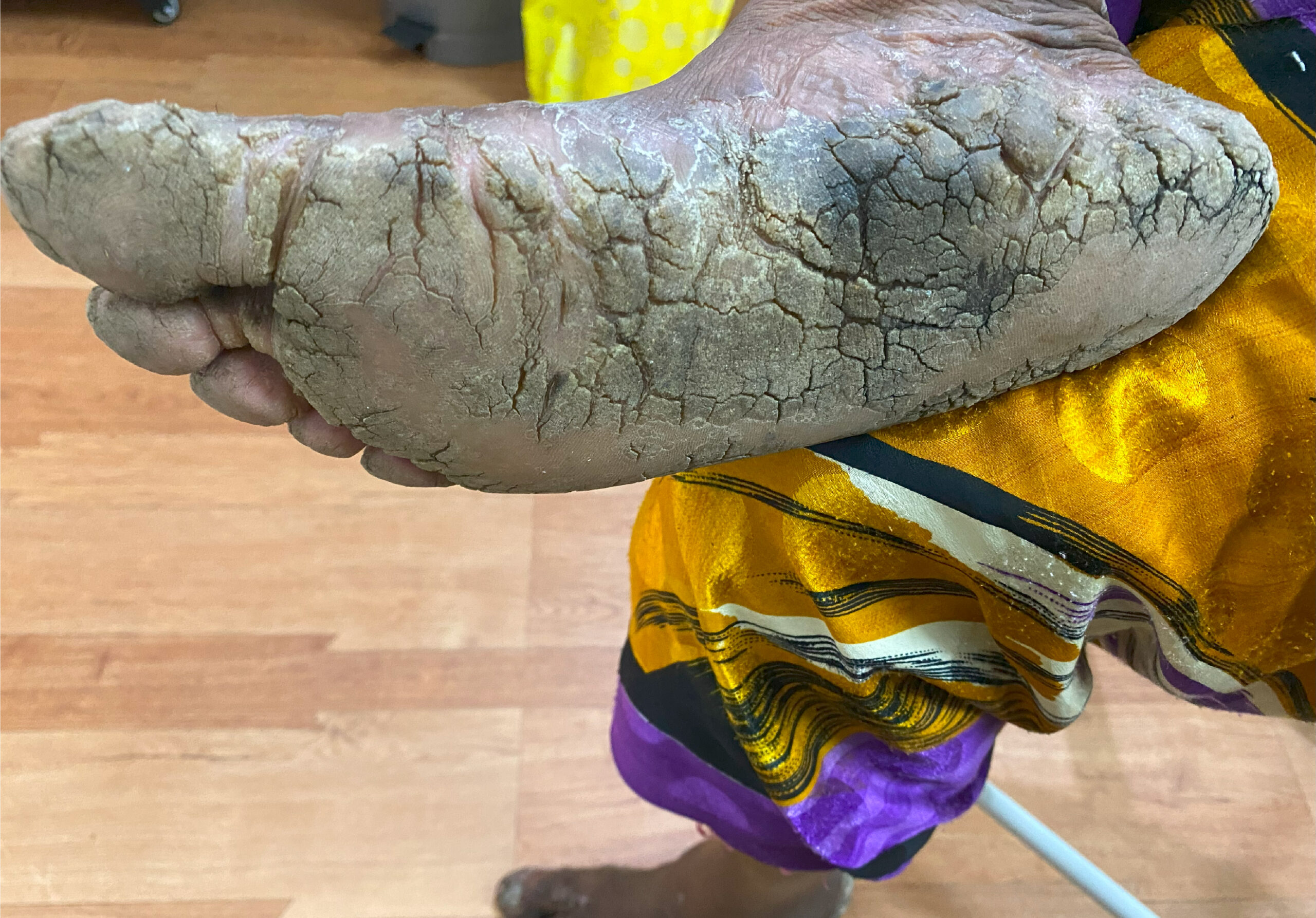 PLANTAR KERATODERMA