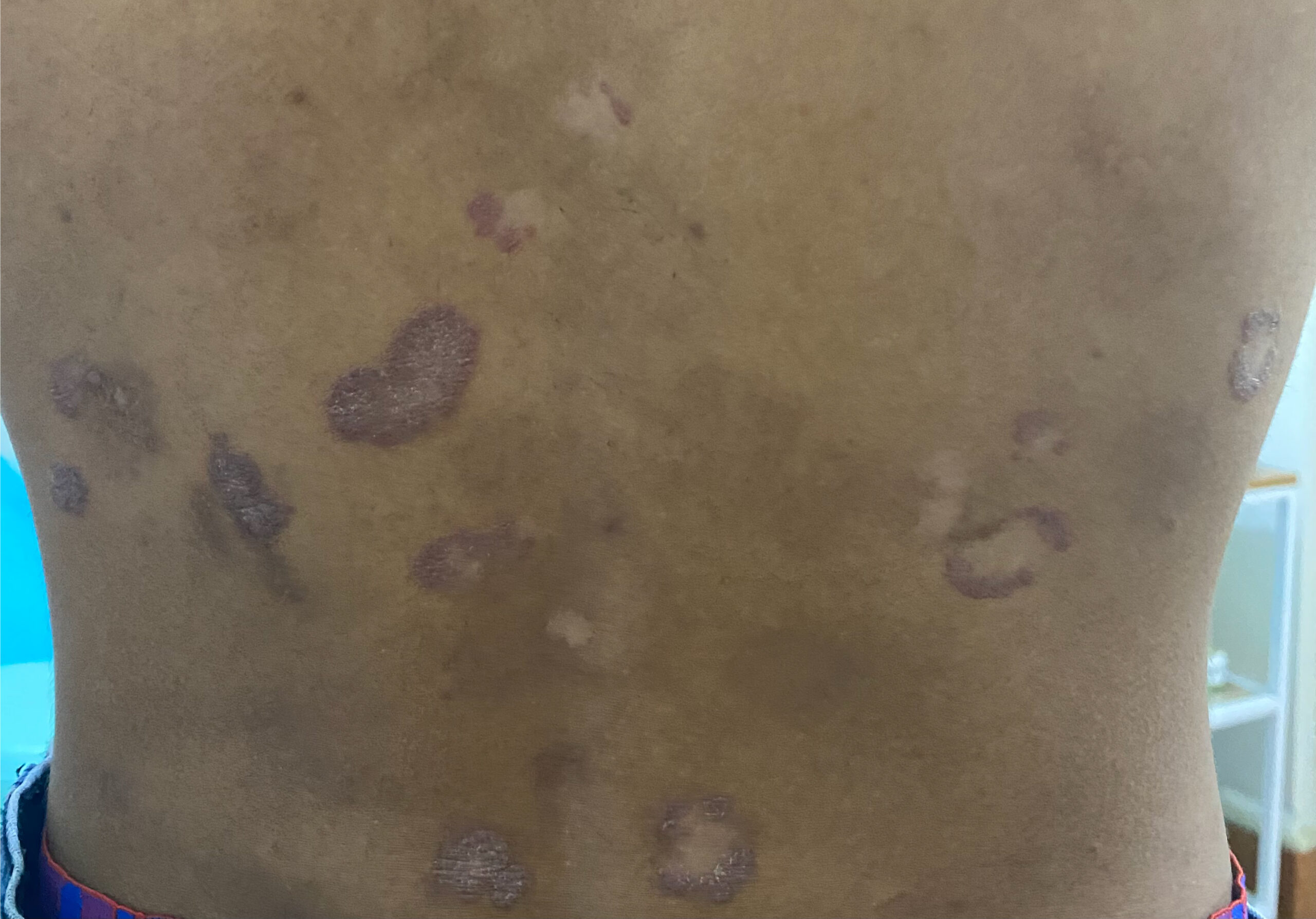 PSORIASIS AFTER TREATMENT