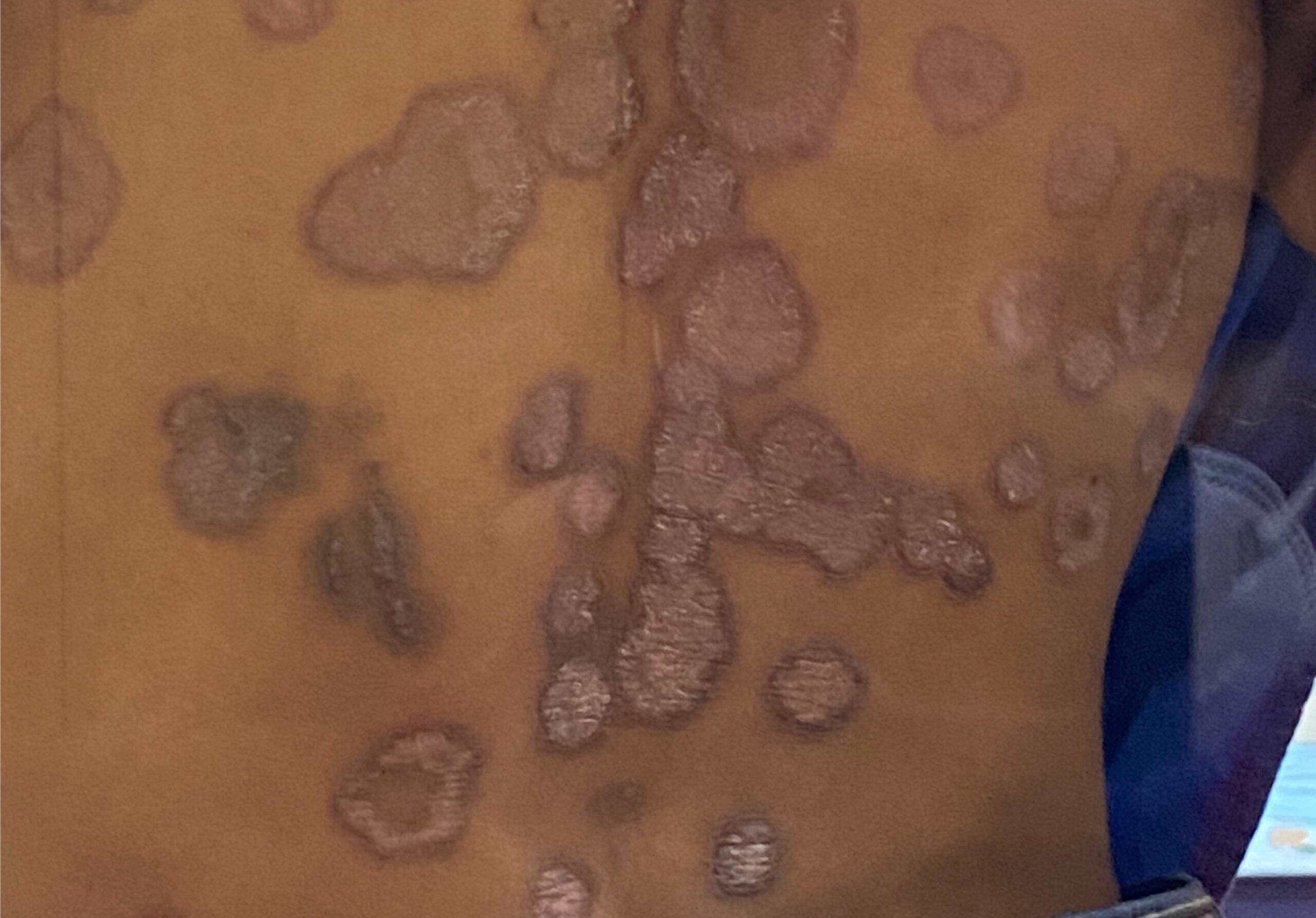 PSORIASIS BEFORE IMG_9345