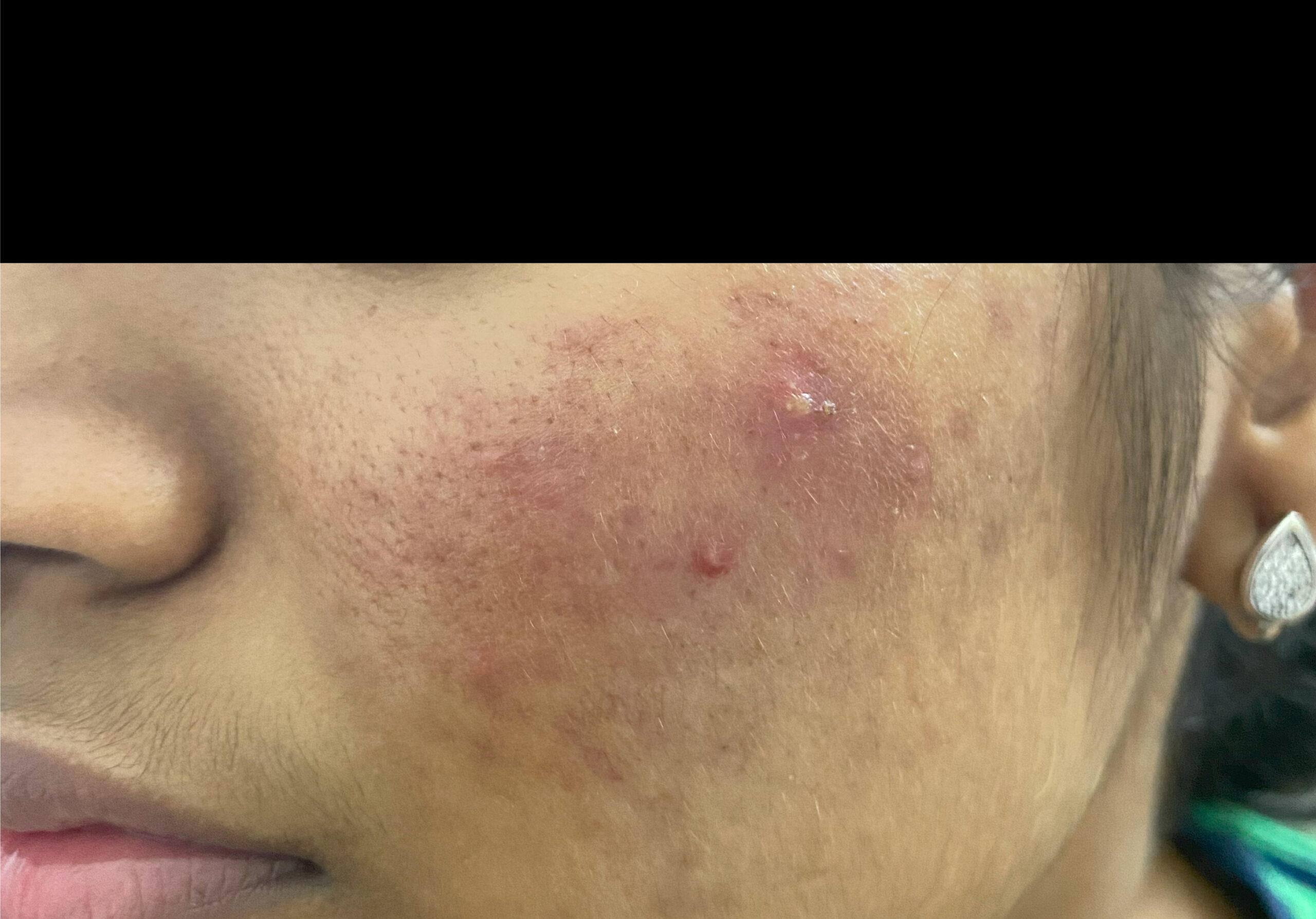 ROSACEA BEFORE TREATMENT