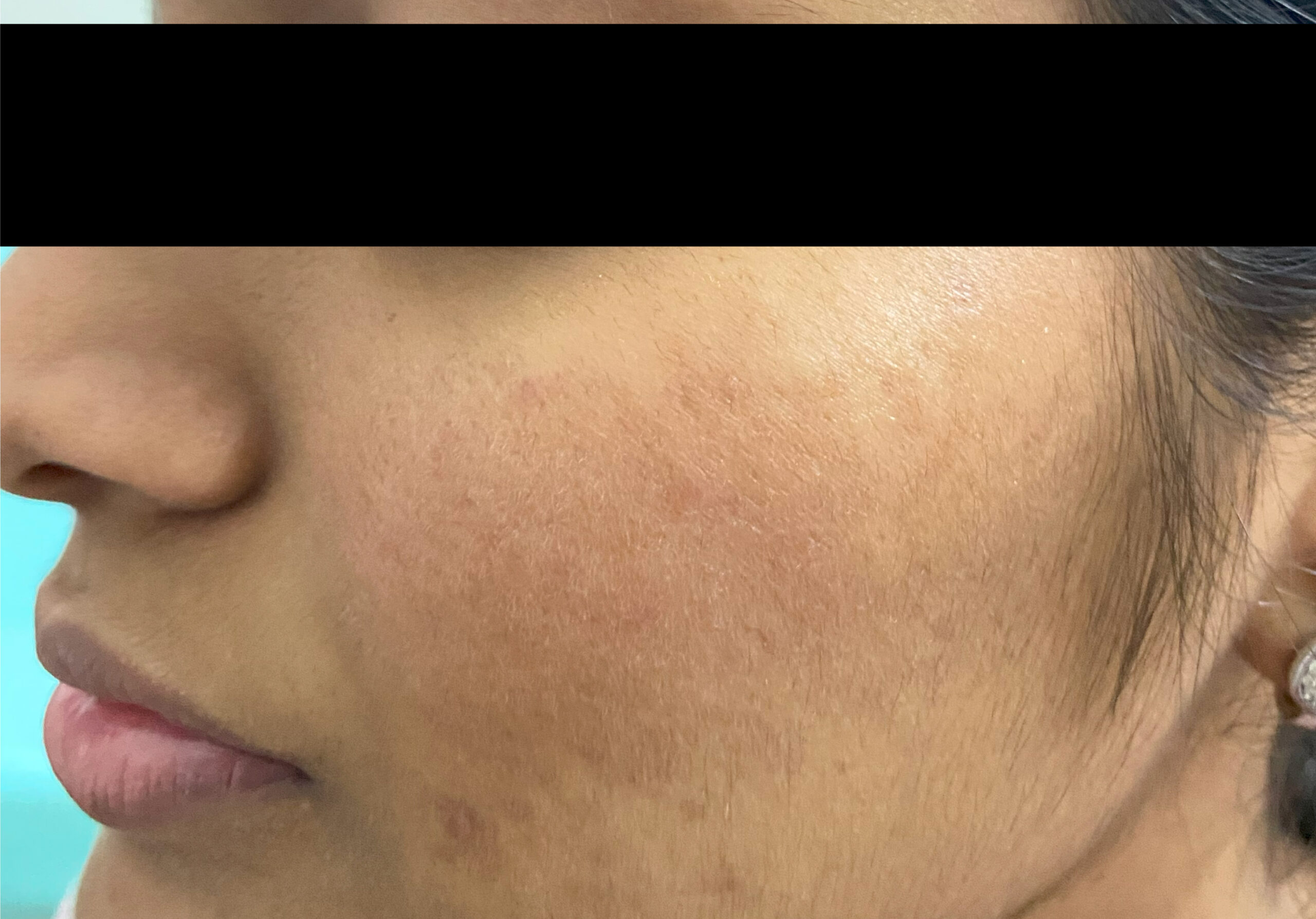 ROSACEA TREATED WITH ORAL MEDICATIONS, LIFESTLE CHANGES, LASERS