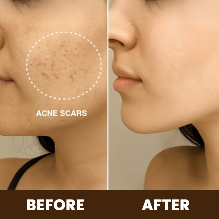 acne scars treatment