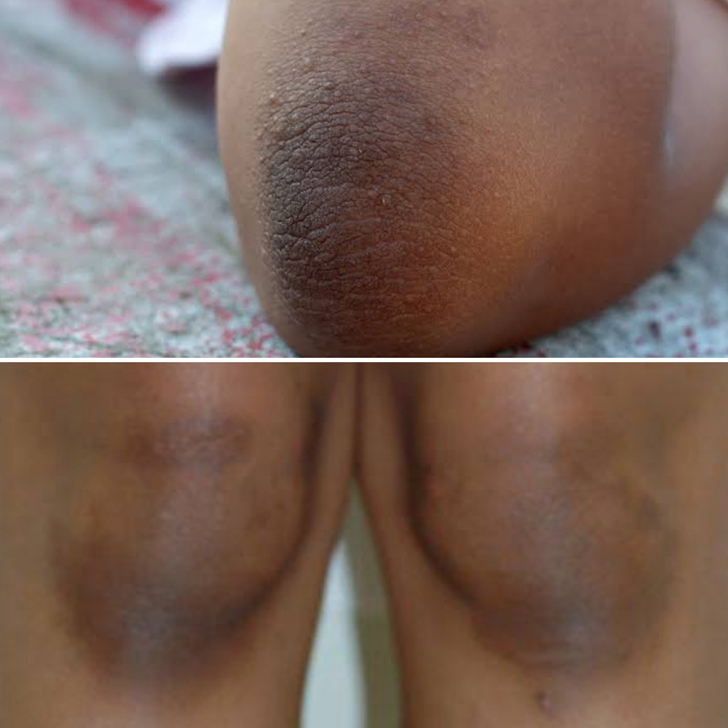 dark knees and elbows treatment