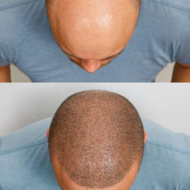 hair transplantation