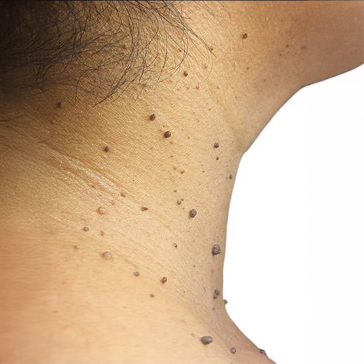 Dermatosis Papulosa Nigra (DPNs)