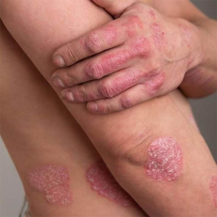 psoriasis treatment