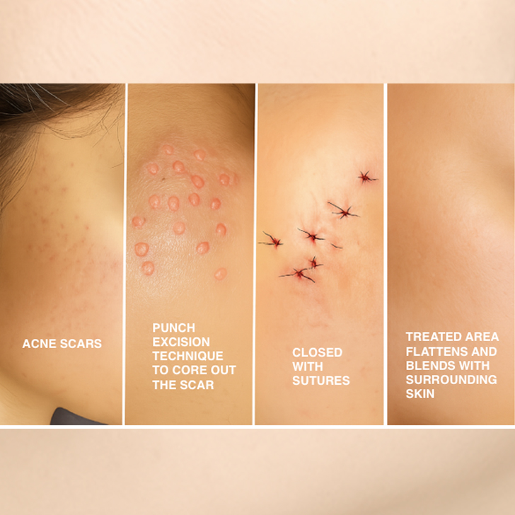 acnescarwithsurgery
