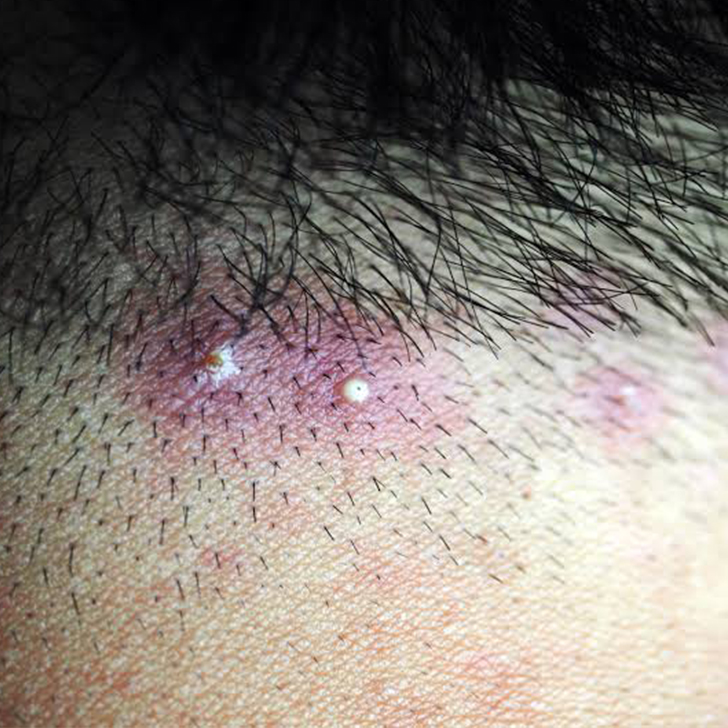 scalp folliculitis
