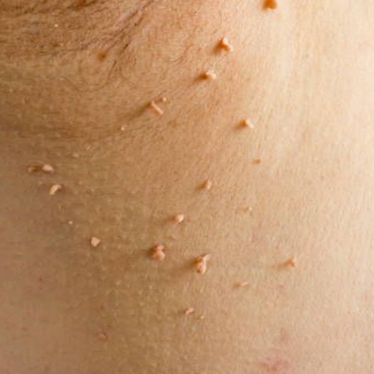 skin tags