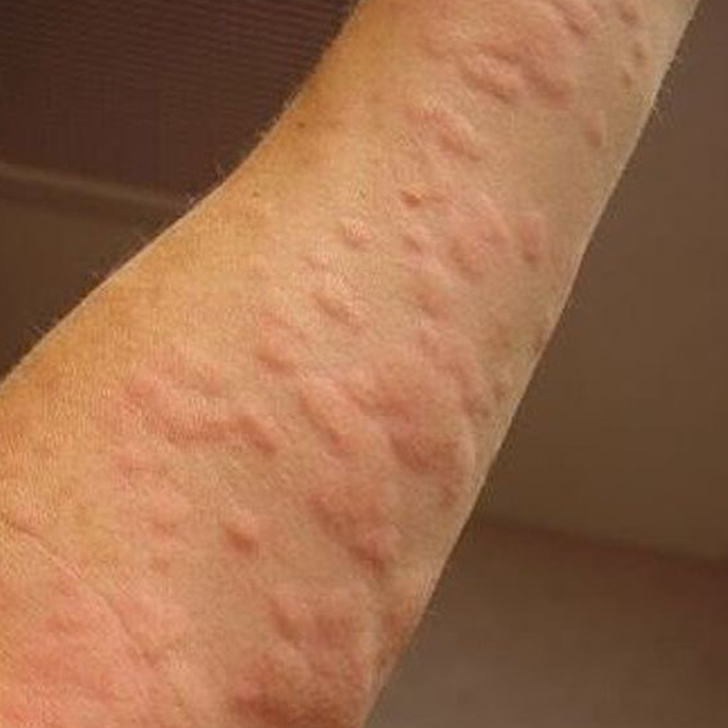 urticaria